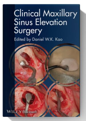 Clinical Maxillary Sinus Elevation Surgery 1st Edition