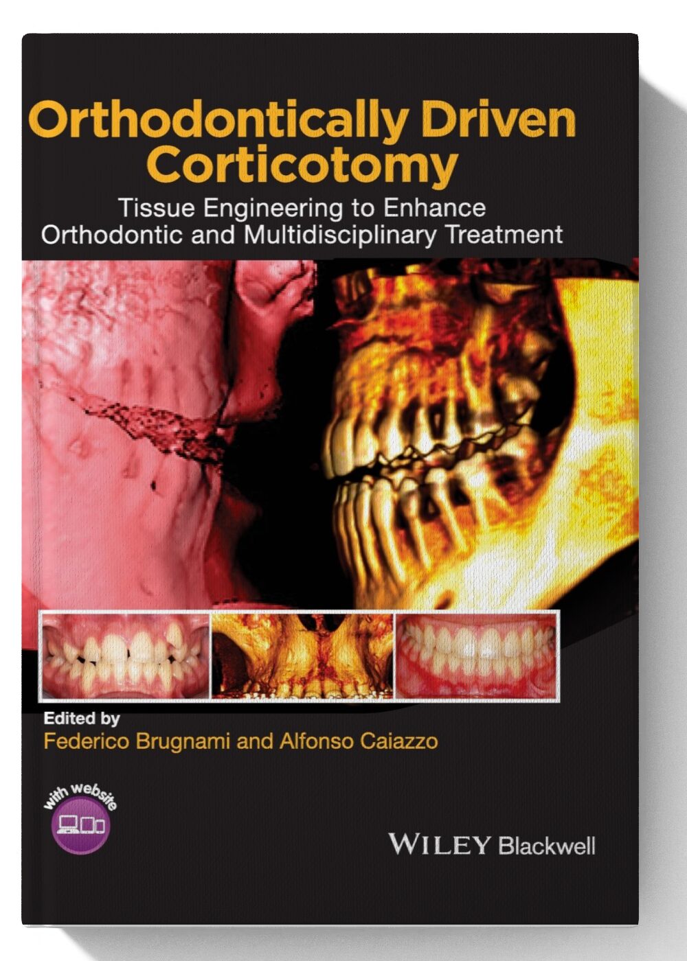 Orthodontically Driven Corticotomy: Tissue Engineering to Enhance Orthodontic and Multidisciplinary Treatment 1st Edition