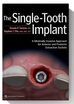 The Single-Tooth Implant: A Minimally Invasive Approach for Anterior and Posterior Extraction Sockets 1st Edition