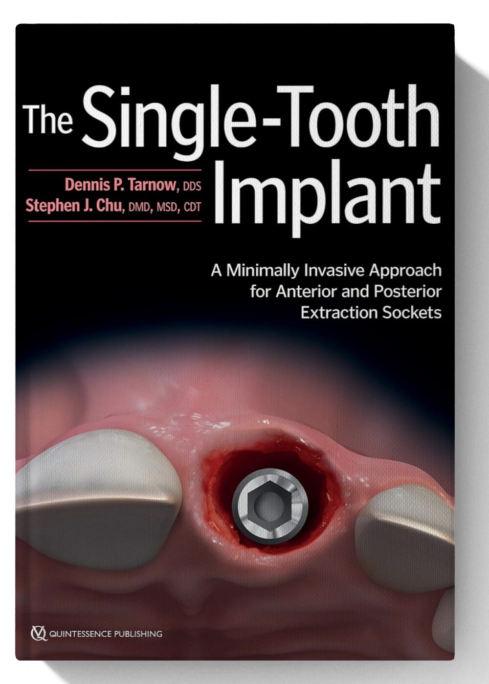 The Single-Tooth Implant: A Minimally Invasive Approach for Anterior and Posterior Extraction Sockets 1st Edition