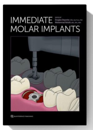 Immediate Molar Implants