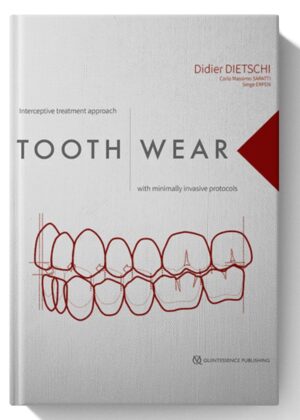 Tooth Wear: Interceptive Treatment Approach With Minimally Invasive Protocols 1st Edition