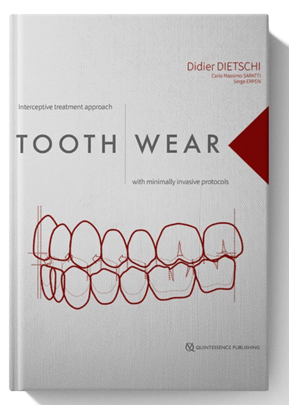 Tooth Wear: Interceptive Treatment Approach With Minimally Invasive Protocols 1st Edition