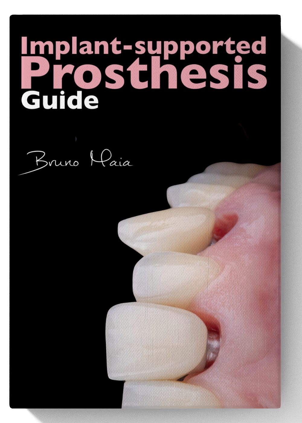 Implant-Supported Prosthesis Guide