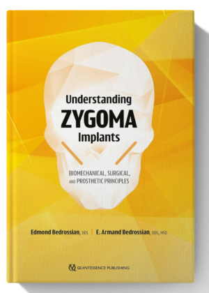 Understanding Zygoma Implants: Biomechanical, Surgical, and Prosthetic Principles