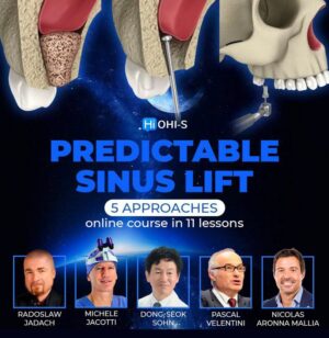 predictable sinus lifting